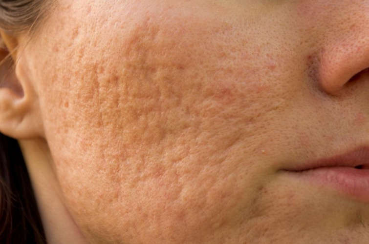 How to get rid of acne scarring